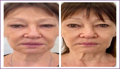 Has Marie Osmond Done Facelift And Plastic Surgery? Before And After Pics, Age And Height