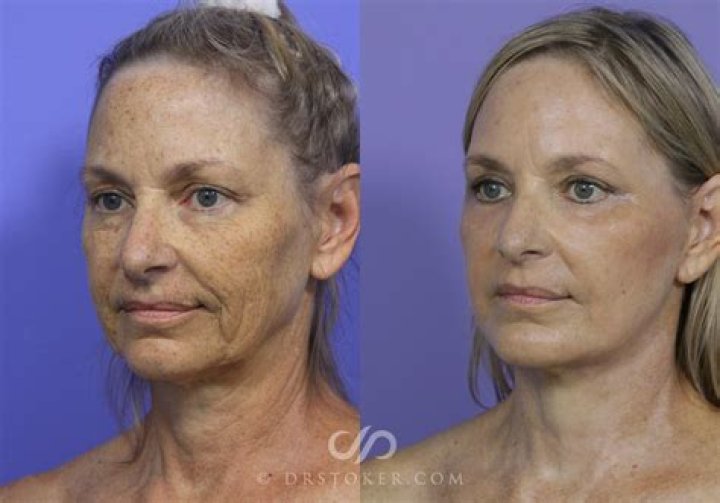 Can you chew food after a facelift?